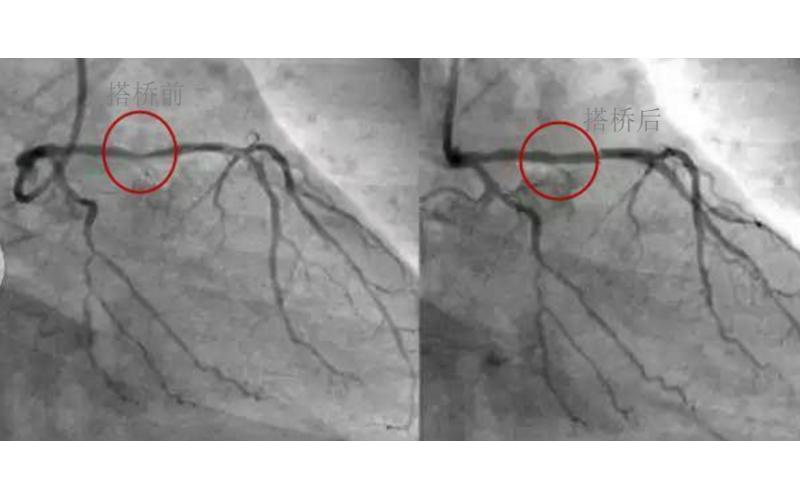 深圳市球盟会官网登录入口厂对心脏支架的关注，国产化的道路有多长？